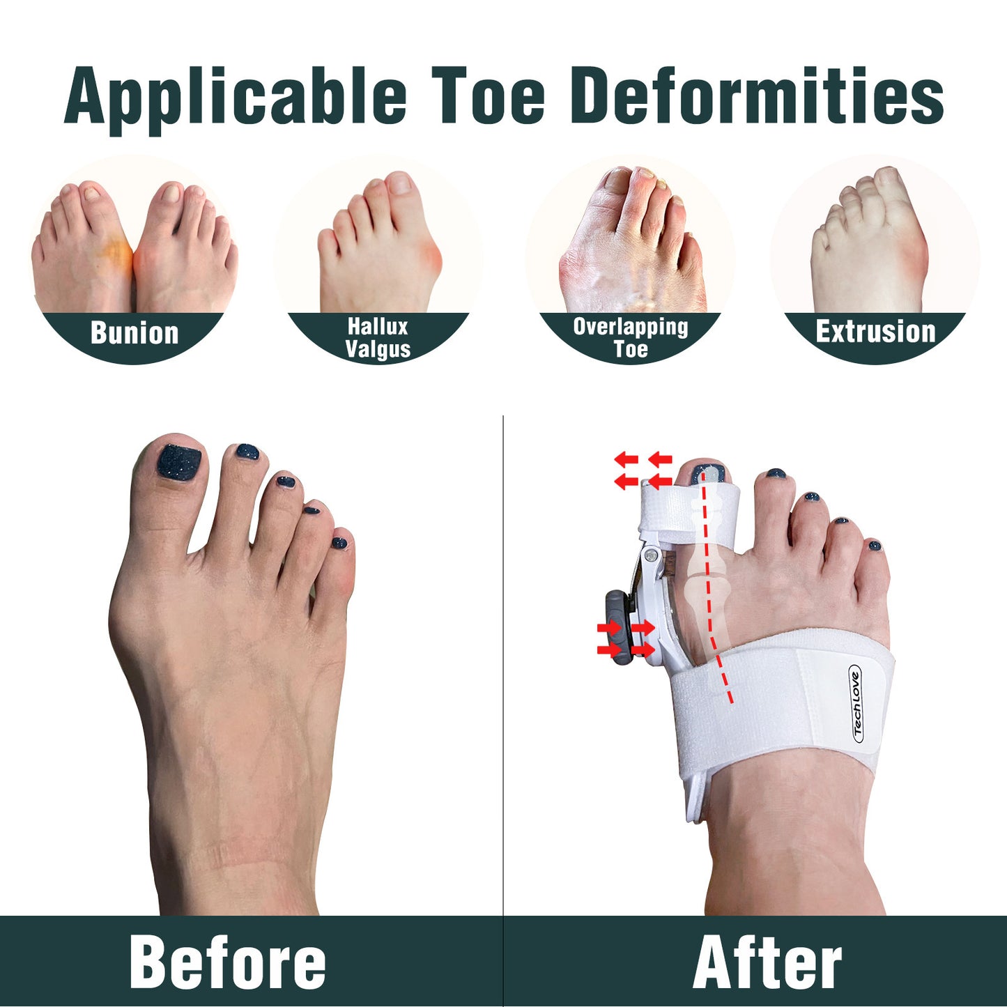 Toe Separator Night Toe Rectifier